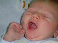 Высыпания на лице у новорожденного