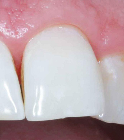А так выглядит зуб после лечения по технологии ICON