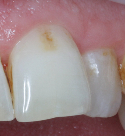 На фото показан пример зуба с начальным кариесом до лечения