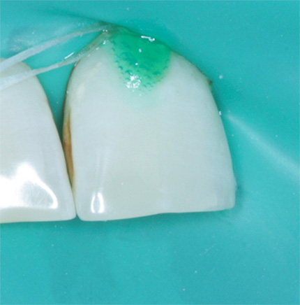 Зуб изолирован от ротовой полости с помощью коффердама, на эмаль нанесен препарат ICON.