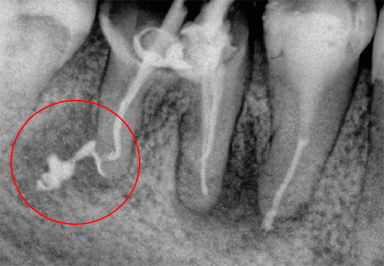 На этом рентгеновском снимке видно пломбировочный материал, выведенный за пределы корня.