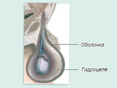 Гидроцеле — осложнения после операции варикоцеле.
