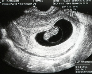 Снимок УЗИ на 9 неделе беременности
