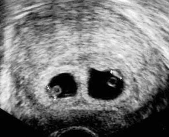 фото узи многоплодной беременности x9;
