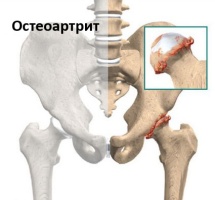 Остеоартрит тазобедренного сустава.