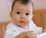 Симптомы атопического дерматита на лице у ребенка