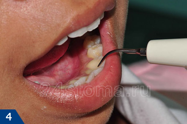 Удаление зубных отложений при помощи ультразвукового наконечника