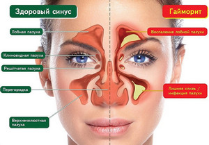 Здоровые носовые пазухи и гайморит