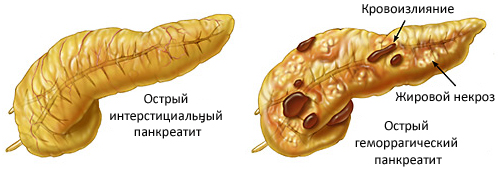 Больная поджелудочная железа у детей
