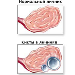 Что такое киста яичника