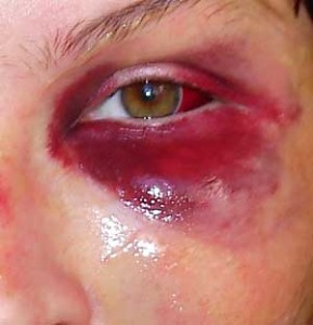кровоизлияние в глаз лечение