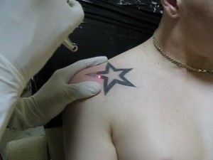 Удаление татуировок лазером Москва
