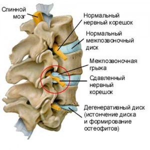 udalenie-gryzhi_1