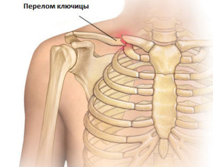 Ключица - это кость, которая соединяет туловище и верхнюю конечность