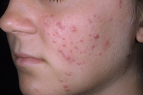 угревая сыпь на лице у взрослого лечение