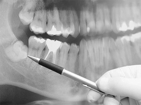 Удаление зубов мудрости из-за их нестандартного расположения в челюсти считается операцией повышенной сложности.