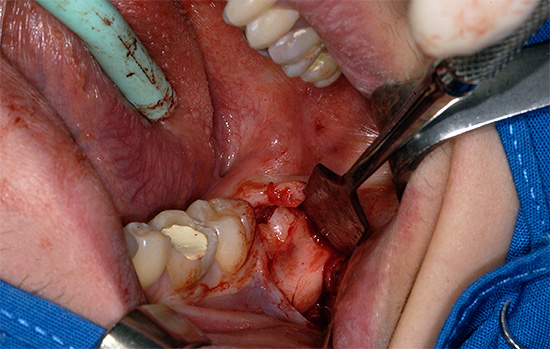 На фотографии показано удаление зуба мудрости с предварительным рассечением десны.
