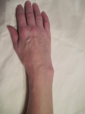 Перелом лучевой кости на правой руке