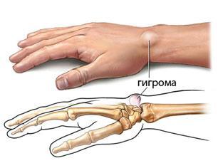 Народное лечение гигромы руки