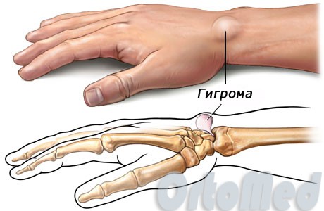 Гигрома запястья фото