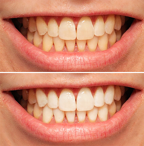 На фотографии показан пример того, как могут выглядеть зубы до и после процедуры фотоотбеливания.