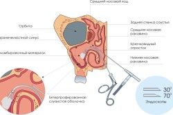 Принцип прокола пазух при гайморите