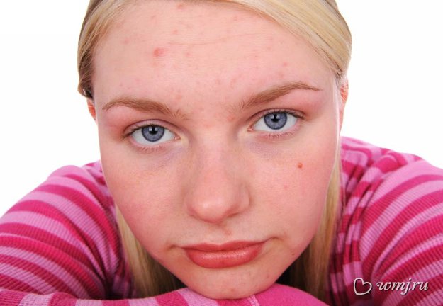 Проблемы с кожей чаще всего начинаются в подростковом возрасте