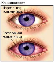 Красные и воспаленные глаза
