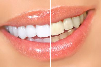 Перекись водорода – это самое популярное средство среди людей в отбеливании зубов