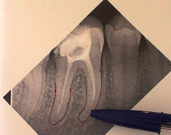 Еще один рентгеновский снимок, где видно, что один зубной канал не запломбирован до верхушки корня.