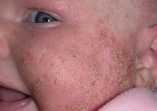 Атопический дерматит на лице ребенка