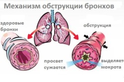 Механизм обструкции бронхов