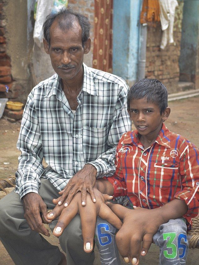 Индийские врачи пытаются помочь мальчику с гигантскими руками