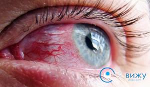 Аллергия, воспалительные и инфекционные заболевания могут вызвать красноту сосудов в белках глаз