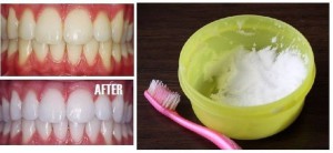 Сода и зубы - фото до и после