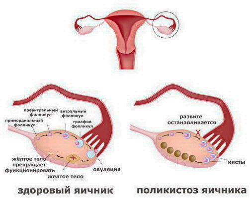 Беременность при синдроме поликистозного яичника